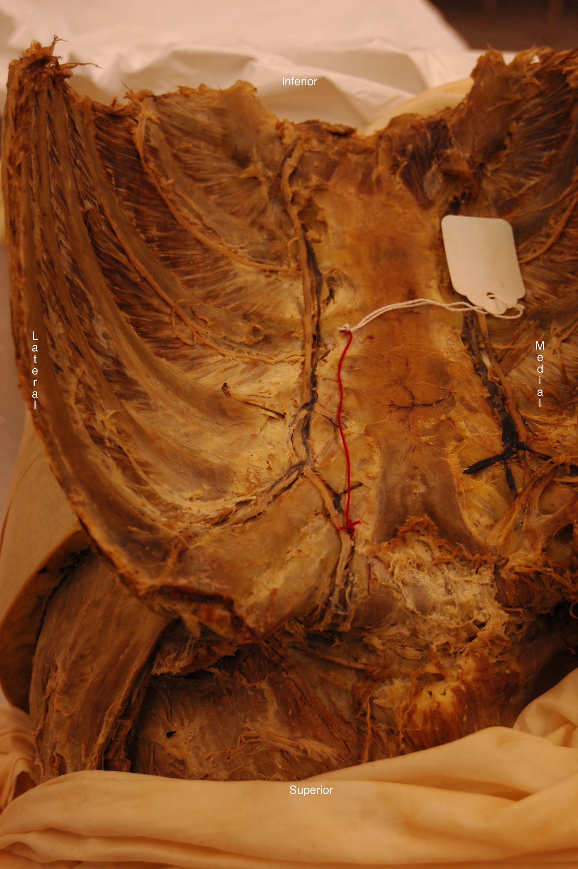 internal thoracic artery cadaver