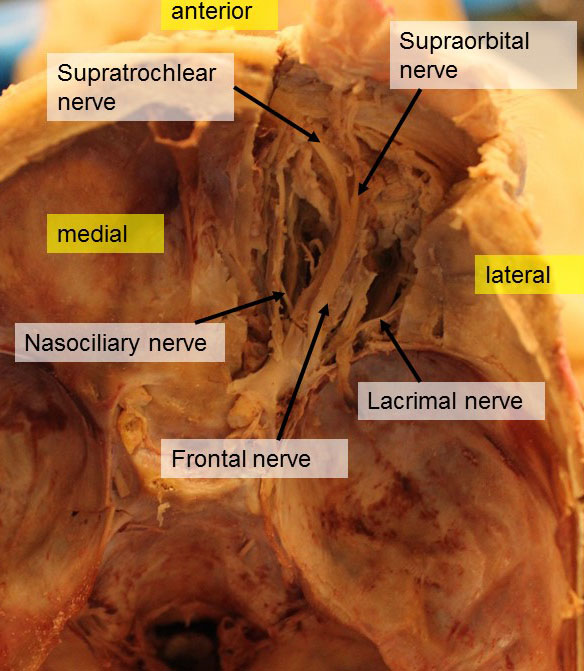 supraorbital nerve cadaver
